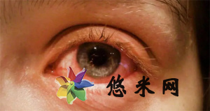感染新冠病毒后眼睛疼痛如何缓解 
